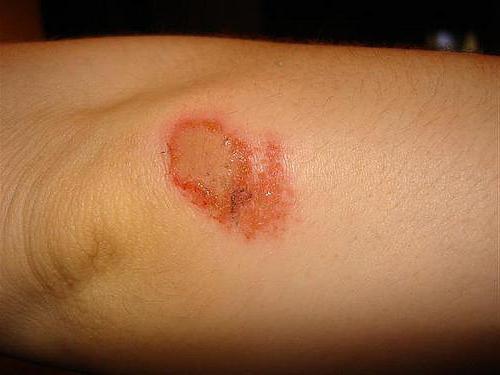 чем лечить ожог в домашних условиях