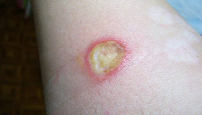 Чем смазать корки после ожога