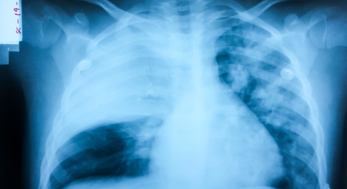 Что такое пневмония?