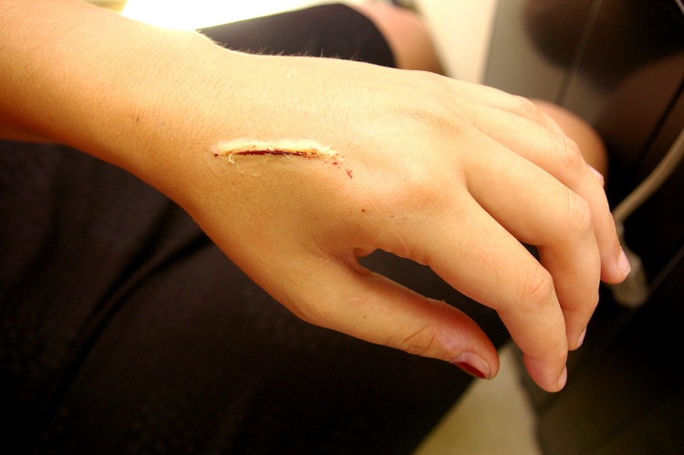 Препараты для рассасывания рубцов после ожогов