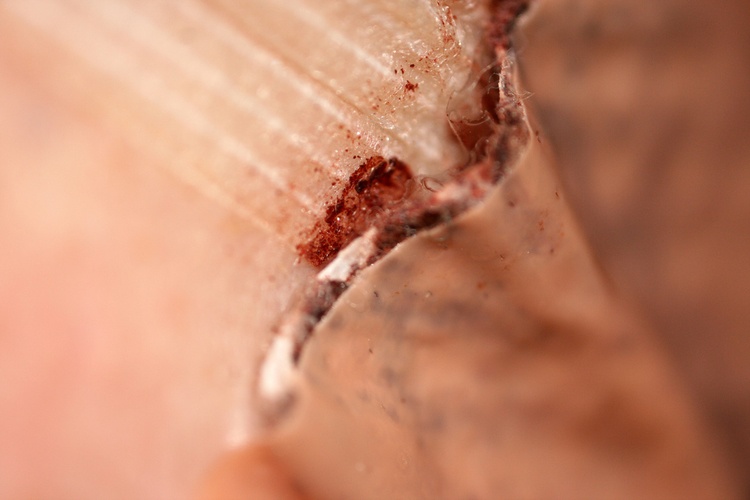 На теле ожог от лейкопластыря