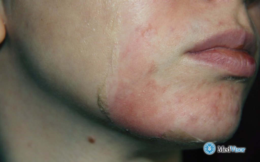 Ожог после салицилового пилинга Избавиться от ожогов салициловой кислотой