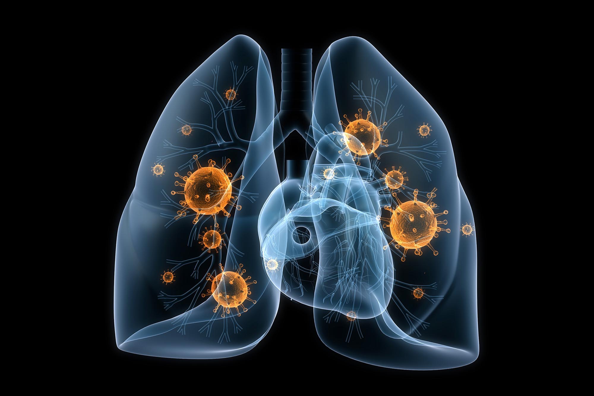 Бактериальная пневмония - лечение