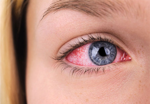 Покраснение глаза после ожога