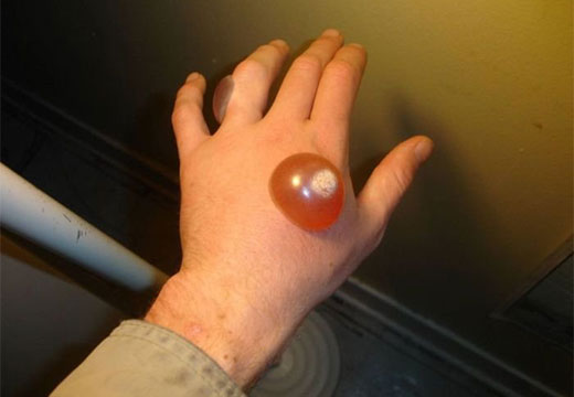 Волдырь после удаления бородавки