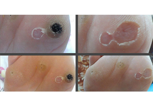 Восстановление после удаления азотом