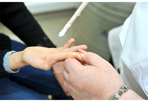 Удаление азотом нароста