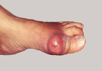 Подагра на фоне сахарного диабета