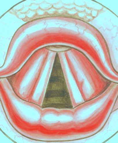 Клебсиелла пневмонии зева, исследуй мазок!