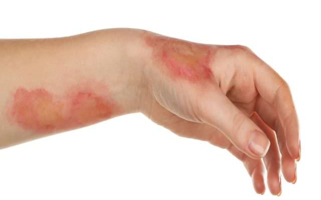 Чем смазать корки после ожога