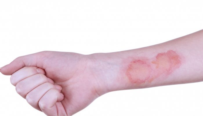 Чем смазать корки после ожога