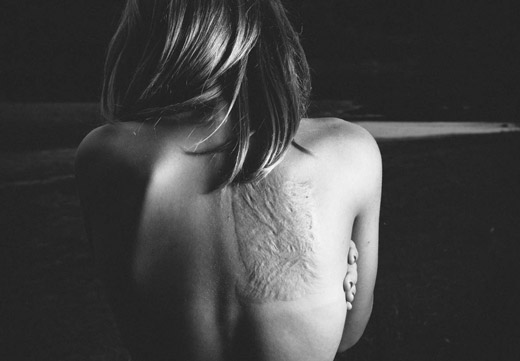 последствия ожога спины