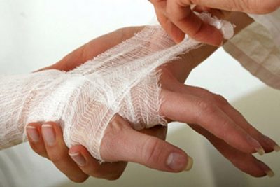 Нужно прокалывать волдыри при ожогах