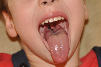 Клебсиелла пневмонии зева, исследуй мазок!