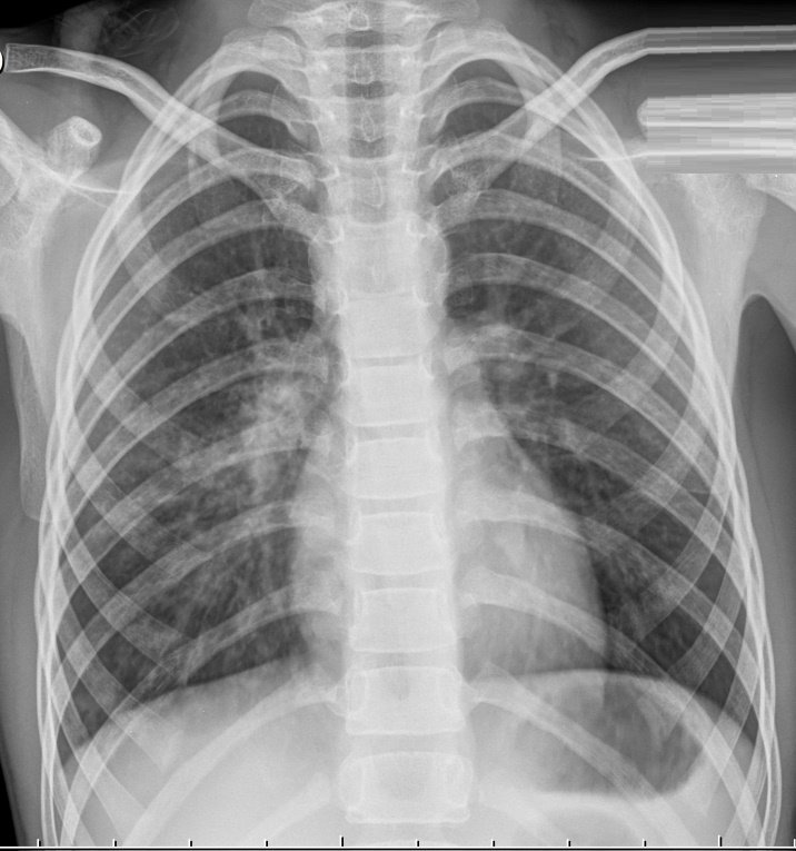 Правосторонняя бронхо- пневмония