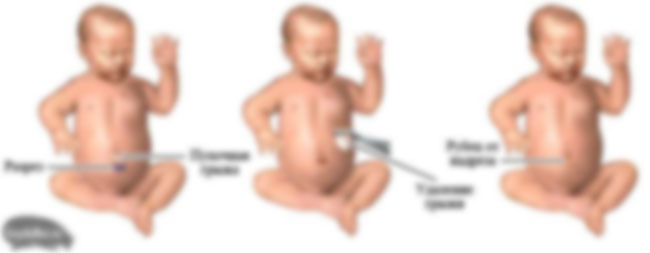 удаление пупочной грыжи