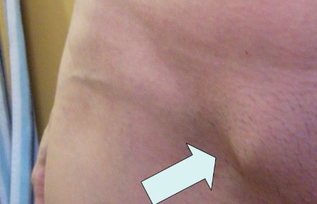 грыжевое выпячивание в паху