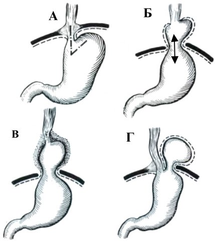 схематическое изображение трех типов грыж пищевода