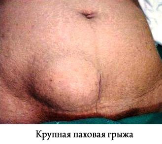 крупная паховая грыжа