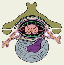 парамедиальная межпозвоночная грыжа