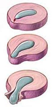 грыжа диска