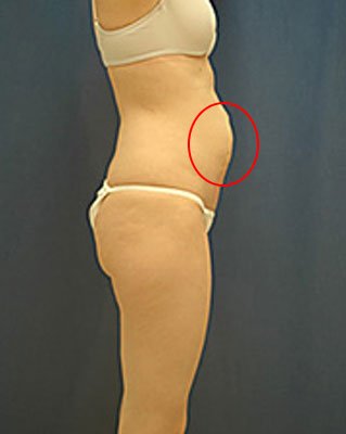 пупковая грыжа у женщин пупковая грыжа у женщин